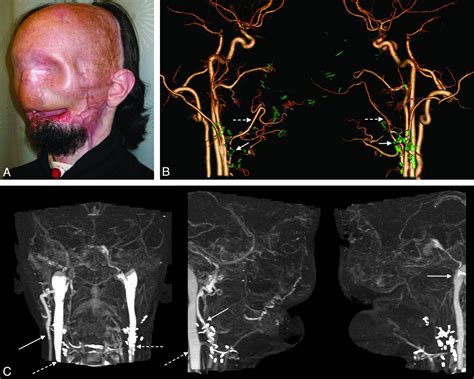 Ct Angiography For Surgical Planning In Face Transplantation Candidates