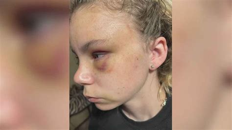 Oklahoma Teen With Cerebral Palsy Lured And Brutally Attacked In Park