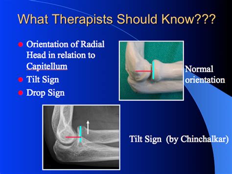 Handrehab Management Of Elbow Disorders Elbow Joint Stiffness