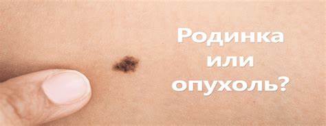 Рак кожи лечение диетой Рак Кожи Фото Лечение — Фото Картинки Рак Кожи Фото Лечение — Фото Картинки Рак кожи лечение диетой