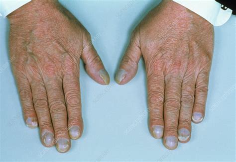 Hands Showing Cyanosis Blueing Of Nail Beds Stock Image M1300048