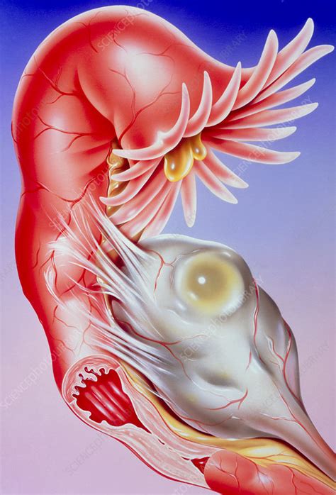 Illustration Of Fallopian Tube Infertility Stock Image M850 0081