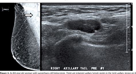 Figure 3 From Abnormal Axillary Lymph Nodes On Negative Mammograms