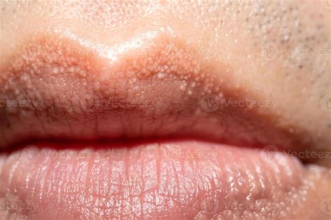 Close Up Of Fordyce Spots On Lips 8902290 Stock Photo At Vecteezy