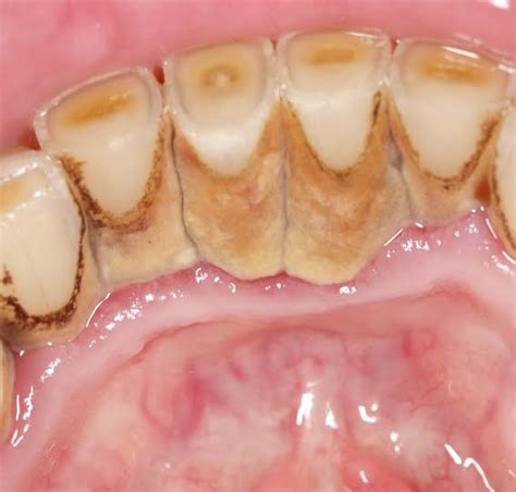 What Are The Effects Of Calculus Deposits On The Teeth