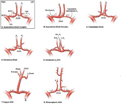 Middle Cerebral Artery Variants Diagrams Radiology Ca