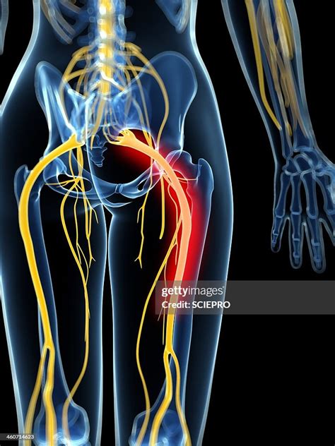 Painful Sciatic Nerve Artwork High Res Vector Graphic Getty Images