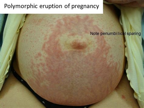 Skin Eruptions Specific To Pregnancy An Overview Maharajan 2013