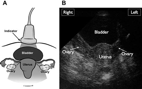 Bedside Ultrasonography For Obstetric And Gynecologic Emergencies