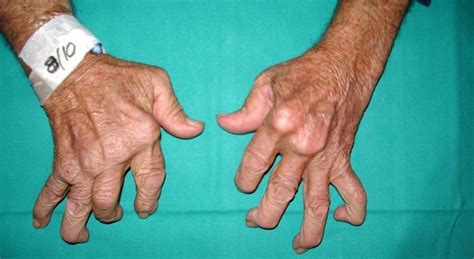 Symptoms Of Rheumatoid Arthritis Things Health