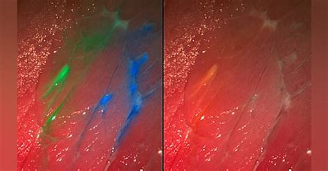 Multispectral Fluorescence Camera Detects Tumors Laser Focus World