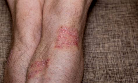 Psoriasis On The Legs What You Need To Know Nuvothera