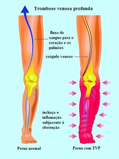 O mais comum é que a dor atinja uma das panturrilhas, direita ou esquerda, podendo ocorrer também no pé. Dor na perna direita ou esquerda, causas e tratamento