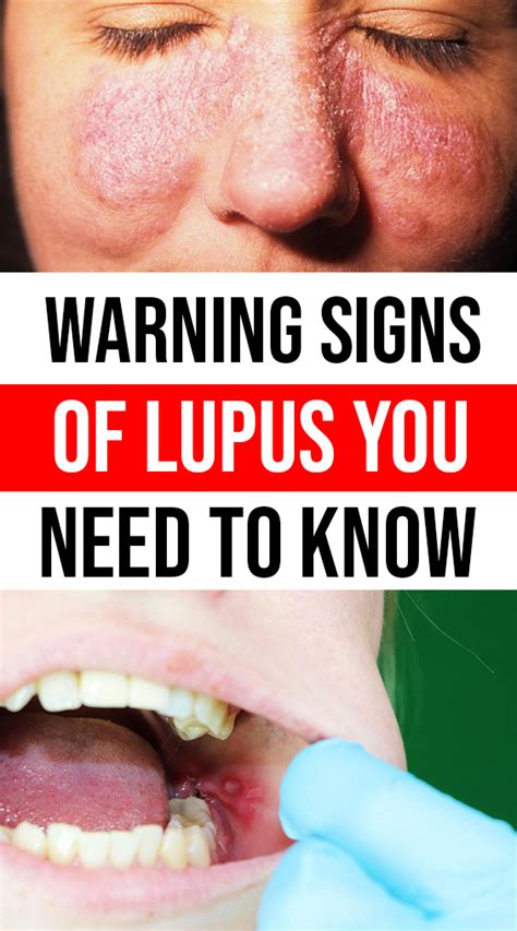 Early Warning Signs Of Lupus You Need To Know And What To Do When You See Them