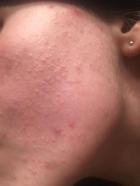 Small Flesh Colored Bumps On Cheeks General Acne Discussion Acne