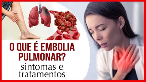 O Que Embolia Pulmonar Sintomas E Tratamentos Youtube