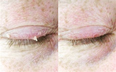 Skin Growth Removal Waxed And Skin Ste 16 At Sola Salons 1940 W