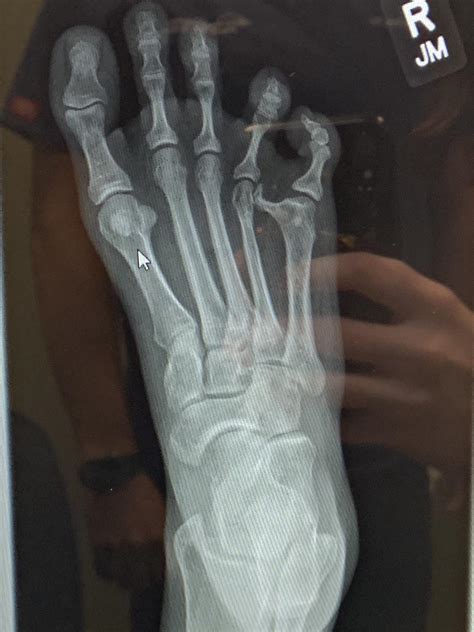 What Does A Broken Pinky Toe Look Like On X Ray Sprained Pinky Toe Or