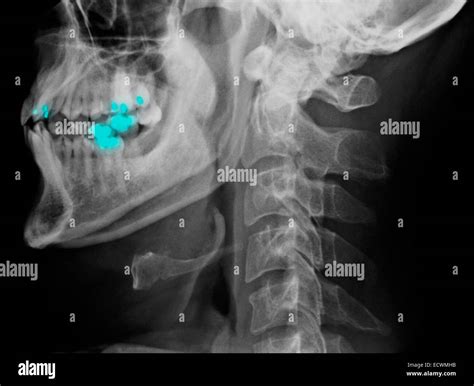 Normal Cervical Spine X Rays Stock Photo Alamy