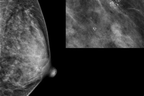 Researchers Reveal Which Benign Breast Disease Is Most Likely To