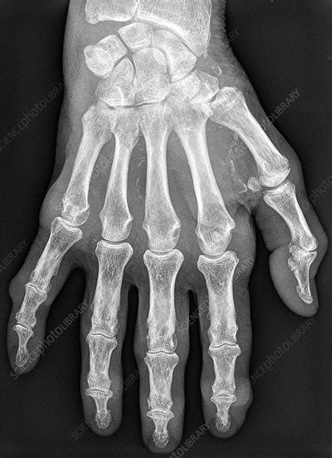 Arthritic Hand X Ray Stock Image C0269051 Science Photo Library