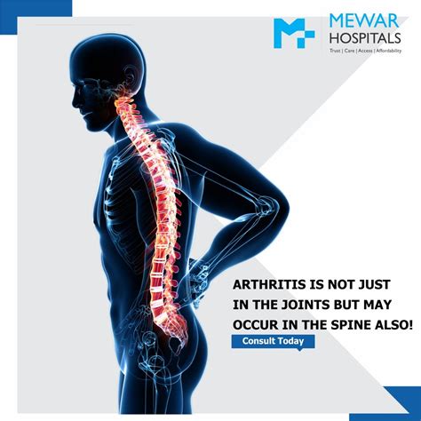 Spinal Arthritis Mainly Affects The Facet Joints The Cartilage Between
