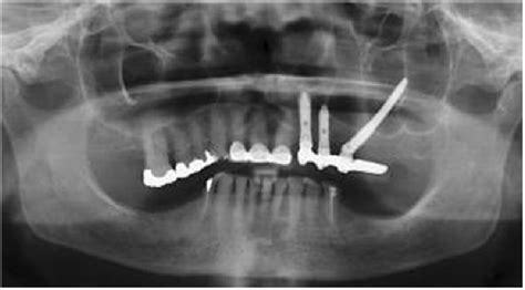 Panoramic Radiograph 12 Month Post Surgery Download Scientific Diagram