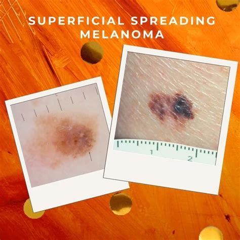 Superficial Spreading Melanoma Melanoma Action Coalition