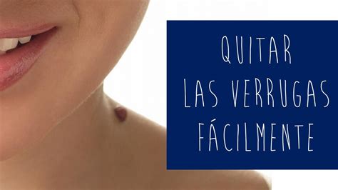 Tratamiento Casero Para Quitar Las Verrugas Del Cuello Elimina