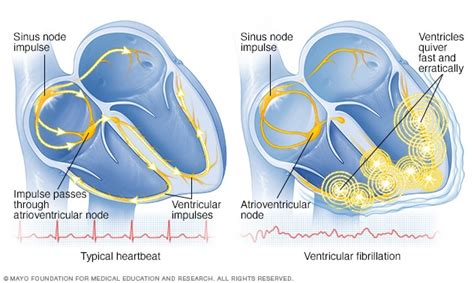 Ventricular Fibrillation Symptoms And Causes Mayo Clinic