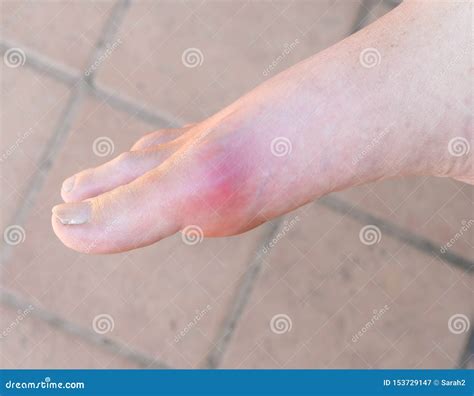 Man With Painful Gout Inflammation On Big Toe Joint Stock Image