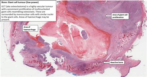 Bone Giant Cell Tumour Nus Pathweb Nus Pathweb