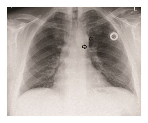 The Ap Chest X Ray Shows The Port Catheter In The Left Sided Superior
