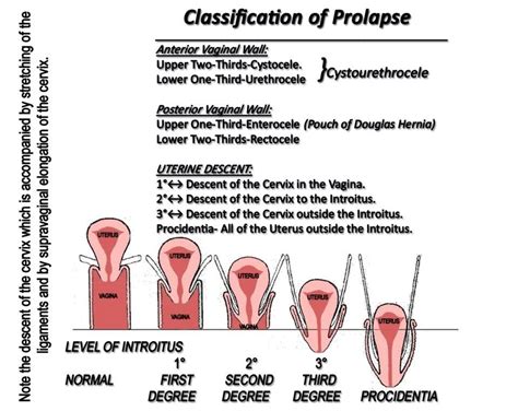 Grading A Prolapse Your Pessary Uterine Prolapse Prolapsed Uterus