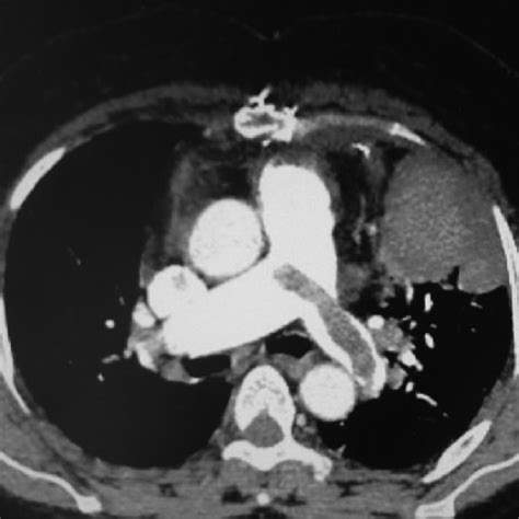Right Main Pulmonary Artery Thromboembolism Extending To The Distal