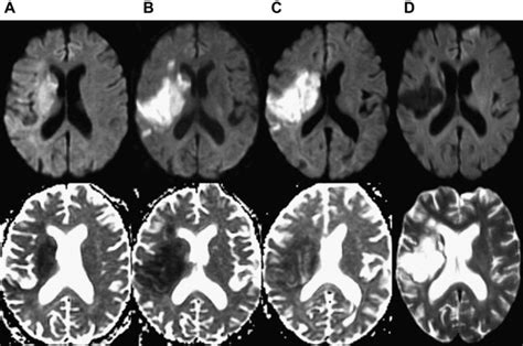 Clinical Applications Of Diffusion Mr Imaging For Acute Ischemic Stroke