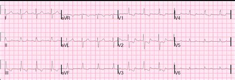 Before discussing ecg axis deviation, we must first understand a very interaction between the flow of electrical energy in our hearts and how an ecg will when you look at a 12 lead ecg and recognise that you do not have a normal cardiac axis, look a little closer. Dr. Smith's ECG Blog: A 30-something woman with chest pain ...