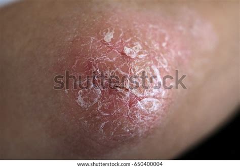Psoriasis Extreme Close Dry Flaky Skin Stock Photo Edit Now 650400004