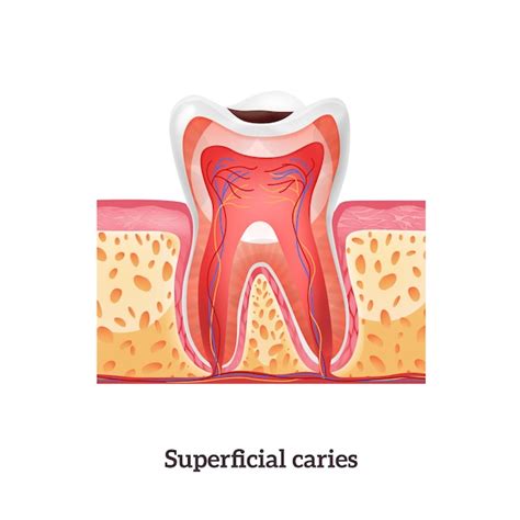 Premium Vector Tooth Anatomy With Superficial Caries