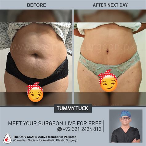 Tummy Tuck Before After Results Cosmetic Surgeon