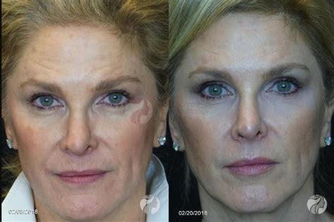 Juv Derm Vobella Xc Before And After Photo Gallery Dallas Tx