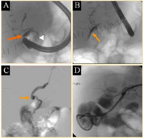 Aandb Ercp Demonstrating Bile Leakage From Chd Arrow In A And