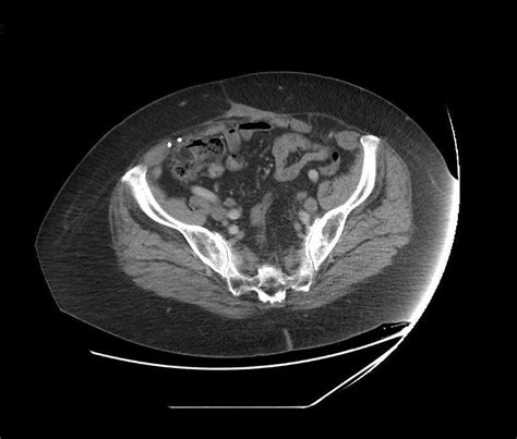 Axial Abdominal Ct Image Of A Left Spigelian Hernia Containing Fat And