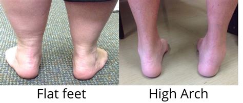 Are Your Flat Feet Causing You Pain Beacon Orthopaedics And Sports
