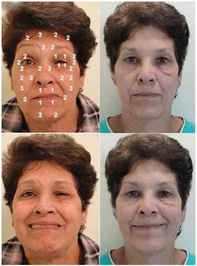 RBCP Protocol For Bilateral Application Of Botulinum Toxin Type A To
