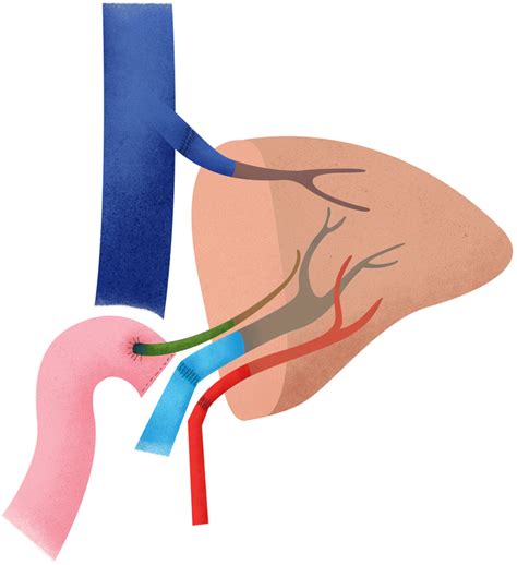 Schematic Illustration Of Left Liver Lobe Transplant Showing