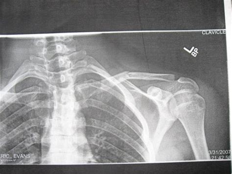 Broken Collar Bone Recovery Time Page 2 Pinkbike Forum