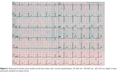 A Case Report Of Borderline Long Qt In Asymptomatic Athlete What