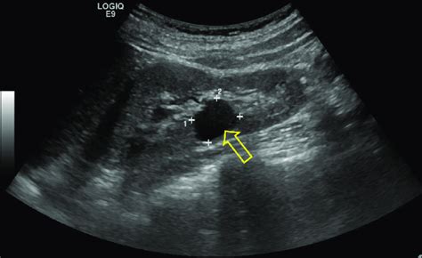 Renal Ultrasound Showing A Renal Cyst Arrow Download Scientific