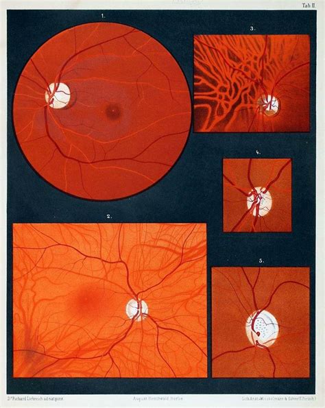 Atlas Of Ophthalmoscopy Representing The Normal And Pathological